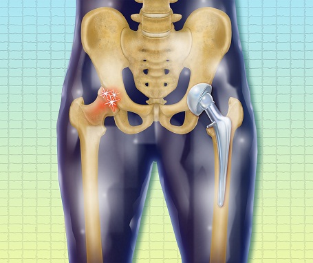 Hip Joint Replacement